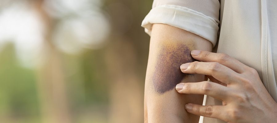 Caring-For-A-Bruise